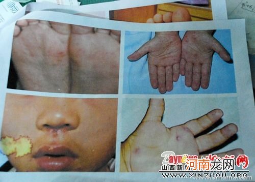 手足口病湿疹的预防措施