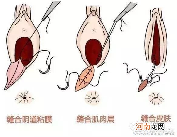 顺产撕裂肛门有疙瘩