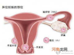 【宫外孕概率有多大】宫外孕的概率有多高_宫外孕的发生率是多少