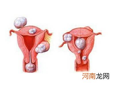 患上子宫肌瘤对胎儿有影响吗