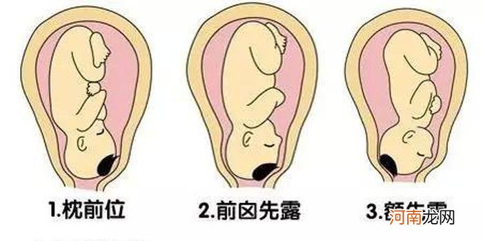 纠正胎位的9个方法