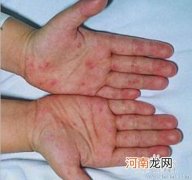 手足口病跟湿疹的区别