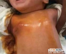 新生女婴要不要挤乳头 关于新生儿乳头护理要注意