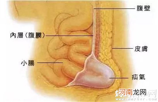 婴儿疝气是什么 宝宝得了疝气到底该怎么办