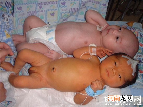 宝宝得了新生儿黄疸怎么办 分清生理性or病理性很重要
