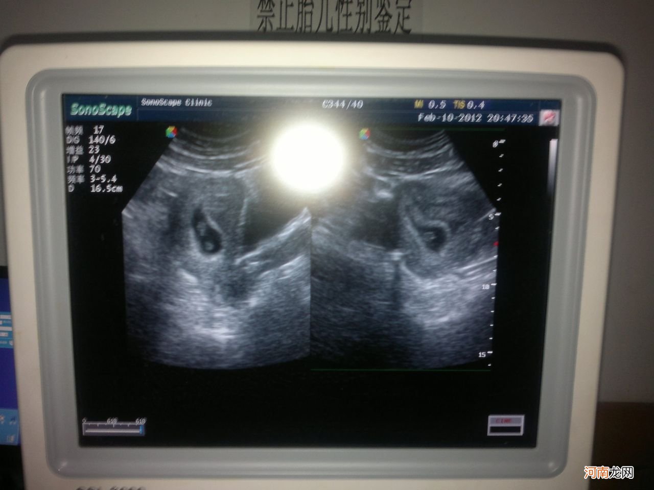 B超图 怀孕两个月胎儿图