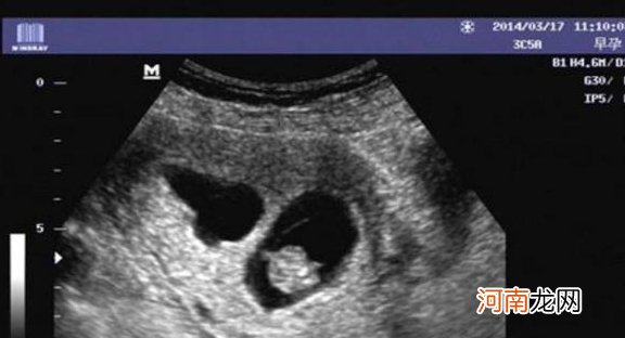 怀孕3周能看见孕囊吗
