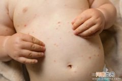 宝宝水痘与手足口病之五大鉴别