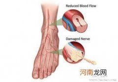 手口足病的防治方法