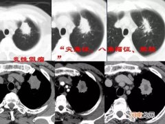 肺结节4a类严重吗