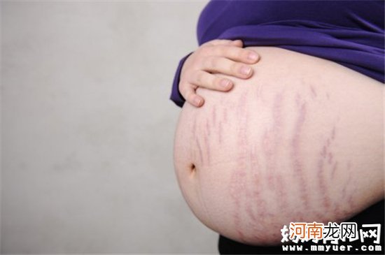 妊娠纹可以预防的吗 孕妈们不得不知预防妊娠纹的方法