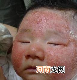 婴幼儿湿疹应如何护理