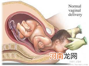 剖宫产PK阴道自然分娩 - 剖腹产