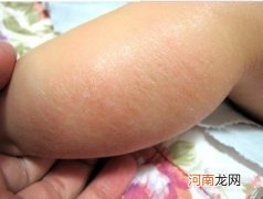 宝宝皮肤干燥可能缺维生素