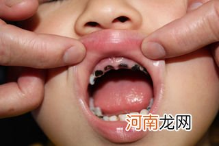 防儿童蛀牙要从出生就开始