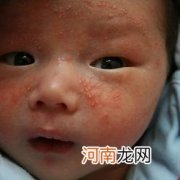 解读婴儿湿疹