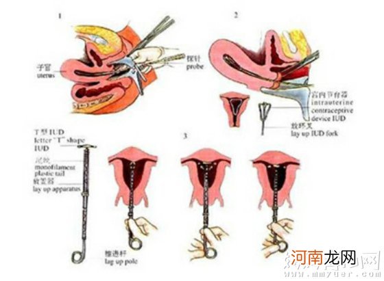 上环痛吗 不宜上环的四种情况请谨记