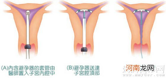 上环后多久可以同房 带环后的六点注意事项