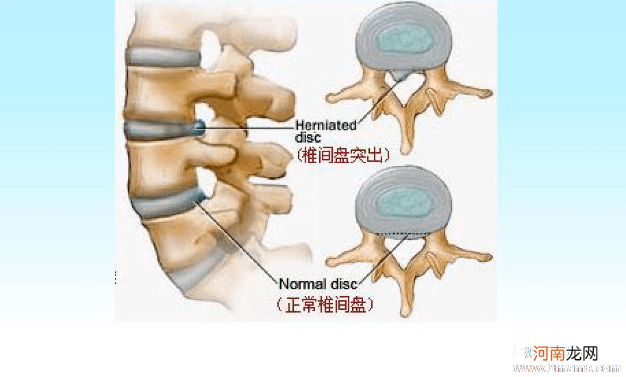 孕期预防腰间盘突出