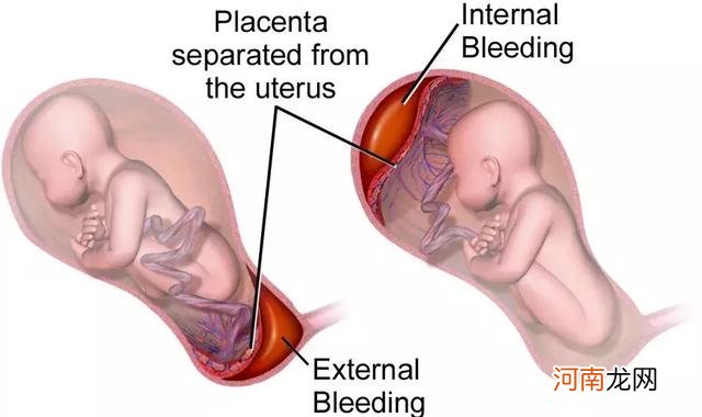 胎盘提前脱落会怎么样