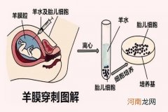 羊水穿刺能查出什么 羊水穿刺检查结果准确吗