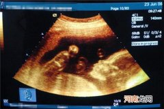 怀孕32周胎儿成活率 预防早产的几个好方法