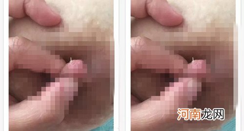 哺乳期奶头有白点,图片好尴尬 原因是什么？