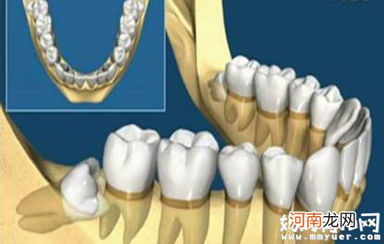 智齿一定要拔吗 告诉你！这三种情况一定要拔掉
