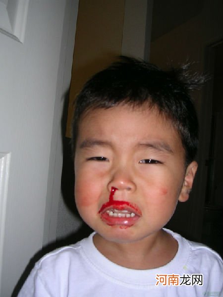 儿童鼻子出血七种常见原因