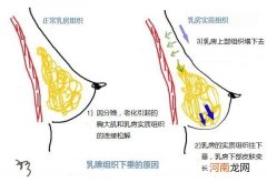 孕妇乳房下垂怎么恢复