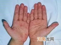 孩子得了手足口病后怎么办呢