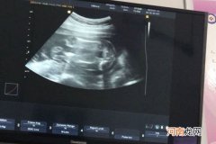 25周看胎儿两腿间平平是女孩 医生：概率较大