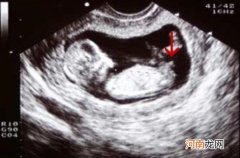 孕13周胎儿男女凸起区别 过来人道出真相