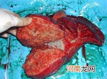 5岁女童爱吃零食惹肝癌