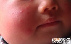 宝宝脸上长很多小红点怎么办 可能是这些原因引起的
