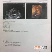 孕期NT查的是什么 怀孕做的nt是什么检查