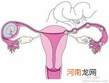 必知：八类女性容易宫外孕