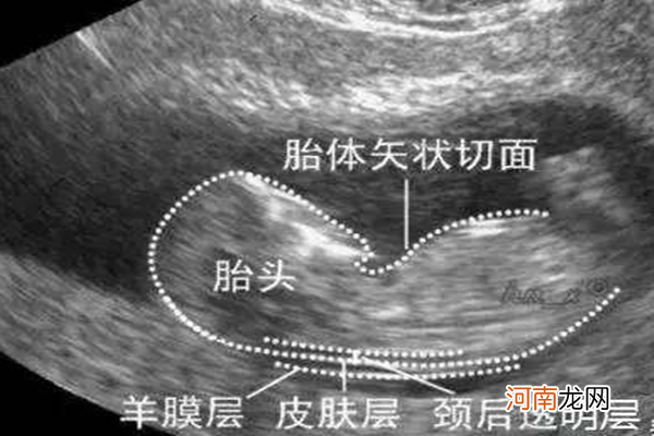 nt检查是阴超还是腹超 nt检查为什么要在14周之前