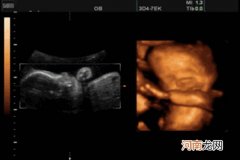 六个月胎儿彩超看男女 怀孕六个月男女区别图