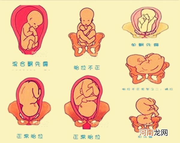 胎位臀位是睡太多的原因吗 胎儿臀位如何纠正能否顺产