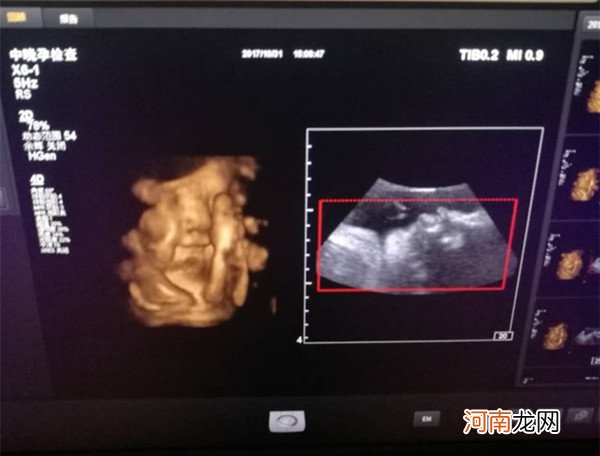 孕26周四维下睾丸的样子 如何看四维彩超识性别
