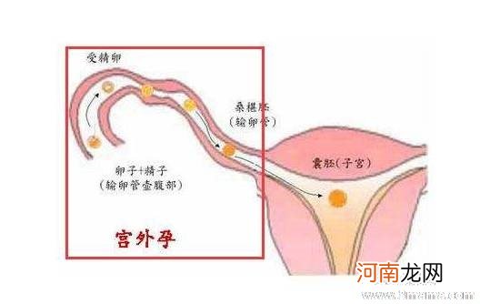 宫外孕的危害有哪些？该怎么预防