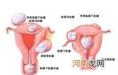 子宫肌瘤患者怎样避孕