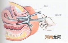 人流多了 乳腺也会增生