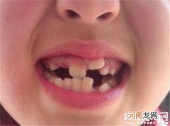 宝宝在多大的时候开始换牙 孩子换牙期要注意这些