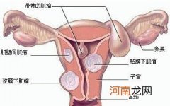 吃避孕药易得子宫肌瘤的