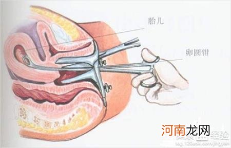 刚做人流两个月又怀孕怎么办