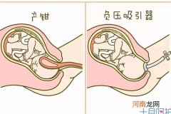 侧切和撕裂哪个好 关系到母子安危还请慎重选择