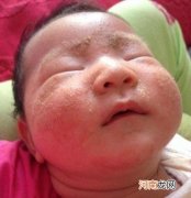 新生儿脸上湿疹能自愈吗 新生儿湿疹多久会自愈