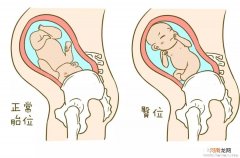 孕晚期臀位怎么纠正